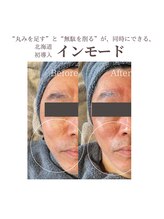 フォルディオ(FORDIO)/インモード[札幌/円山]