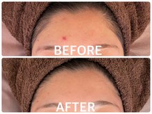 ハーブピーリング 心斎橋/背中ニキビ改善