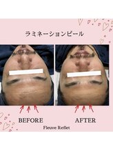 フルーヴ ルフレ(Fleuve Reflet)/男性にも人気♪韓国ピーリング