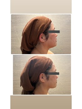 バンブー B2 新涯店(Bamboo)/フェイシャルグラヴィティ1回