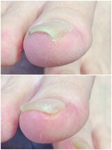 モアクリスタル(More Crystal)/巻き爪補正