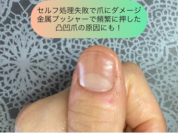 桃の木 吉祥寺店/甘皮セルフケア失敗でダメージ