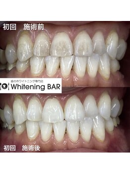 ホワイトニングバー 名古屋栄店/ヤニ汚れにも！初回で効果発揮