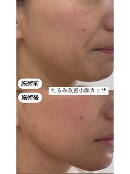 ポレ(pole)/たるみ改善★小顔カッサ