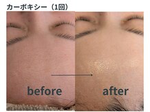 ミジタク 京都二条店(mijitaku)/カーボキシー1回のお肌