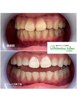 ホワイトニングサロン 名古屋駅店/【ホワイトニング施術例】