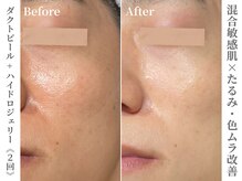 ゼアー(THERE FY.)/揺らぎ肌の改善にはこちら