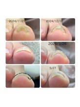 ナチュエイド/巻き爪矯正