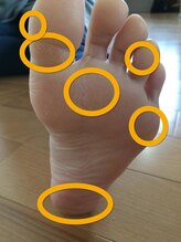 オーサポート(O-support)/丸印に魚の目などありませんか？