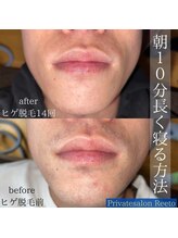 リエート(Reeto)/メンズ脱毛