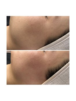 ホワイトワックス 京都四条烏丸(WHITE WAX)/《全顔》フェイシャルワックス