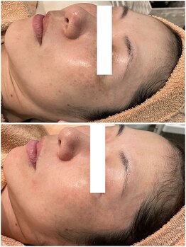 リッツ 浦和ボディ店(Ritz)/【Before/After】シミ改善