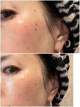 グロー(GLOW)/光フェイシャル