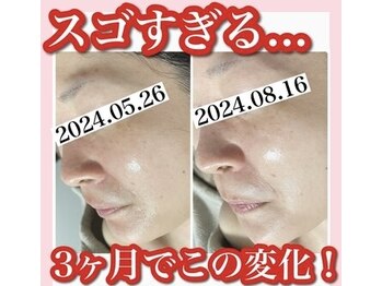 ホワイトアクア 池袋店(WHITE AQUA)/ハーブピーリング/毛穴洗浄/池袋