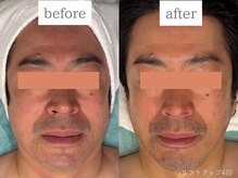 ケリーズ(KELLY `S)/光リフトアップ