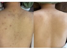 剥けるハーブピーリングで肌質改善/ニキビケア3回目の施術効果