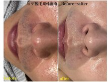 サロンベース(salon BASE)/『人気の部位』顔・ヒゲ脱毛