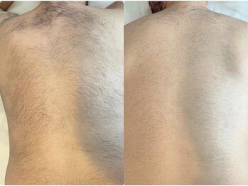 アンベリール(Embellir)/男性ワックス脱毛/1回目→2回目