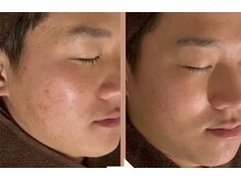 毛穴・ニキビ・肌質改善特化サロンeto.【毛穴/ニキビ/ハーブピーリング】の雰囲気（男性のお客様も大歓迎◎ハーブピーリング！！）