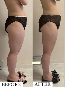 フェミニー(Feminy)/固い脂肪も！！