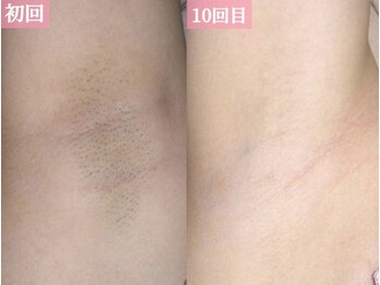 エピア 半田店(Epia)/脇【シェービング付】