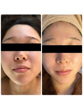 ベルージュ(Belrouge)/最新マシンでリフトアップ