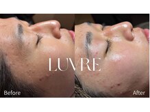 ルーヴレ(LUVRE)/フェイシャルWAX