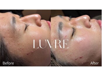 ルーヴレ(LUVRE)/フェイシャルWAX