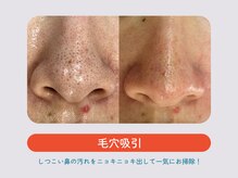 ソウルスキン/毛穴吸引☆
