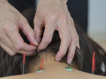 小林はり灸