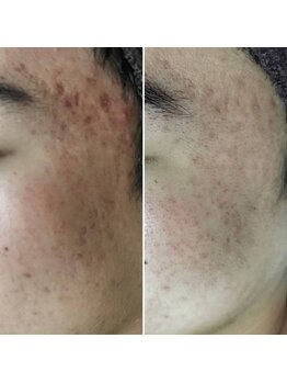 お顔そりローズマリー/ハーブピーリング