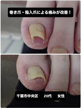 巻き爪・陥入爪の痛みを改善！
