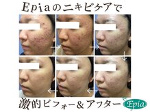 エピア 岡崎店(Epia)の雰囲気（長年悩んでいた肌荒れもEpiaのニキビケアで肌改善に導きます！）