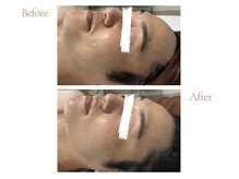 ヨルエステ(yoru aesthe)/【エイジングケア、美白ケア】