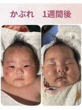 ララスマイル 鶴崎森町店/かぶれが綺麗になりました