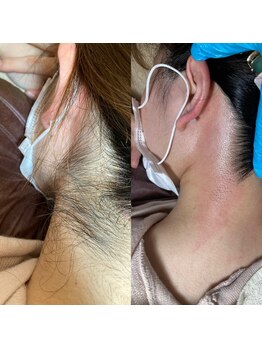 ワックスラボ(WAXLAB)/うなじワックス+うなじ光