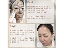 ハーバリー ハーブピーリング 岐阜(HERBERRYハーブピーリング)/最強ハーブピーリング【リベル】