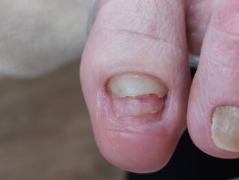 爪切り屋 足楽/50代女性◆鉤弯爪