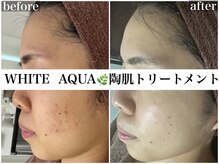 ホワイトアクア 京都店(WHITE AQUA)/ハーブピーリング