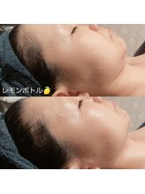 マイフェアレディ 今池(MyFairLady)/韓国美容レモンボトル小顔エステ