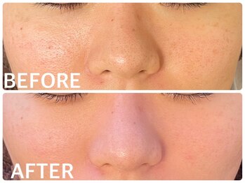 ハーブピーリング 心斎橋/ハーブピーリングで毛穴ケア