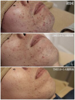 ベビースキン(baby skin)/肌荒れ改善×髭脱毛