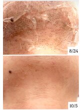 リアン(Rian)/ひげ脱毛 ／ 光脱毛