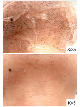 リアン(Rian)/ひげ脱毛 / 光脱毛