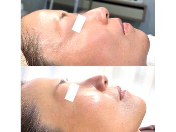 ビタザボナ(Vita the Bona)/幹細胞フェイシャル