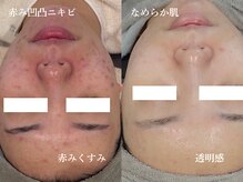 ルミエール 白金台uniside店の雰囲気(毛穴を整えて育てることで、赤み凹凸ニキビもここまで改善します)