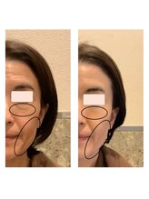 アクア エステティコ 亀有(ACQUA estetico)/シリカニードルピーリング前後