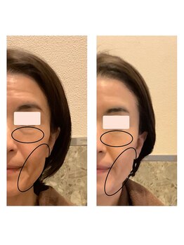 アクア エステティコ 亀有(ACQUA estetico)/シリカニードルピーリング前後