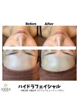 アクシア ビューティー サロン(AXSIA)/【ハイドラ】Before After