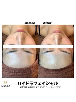 アクシア ビューティー サロン(AXSIA)/【ハイドラ】Before After